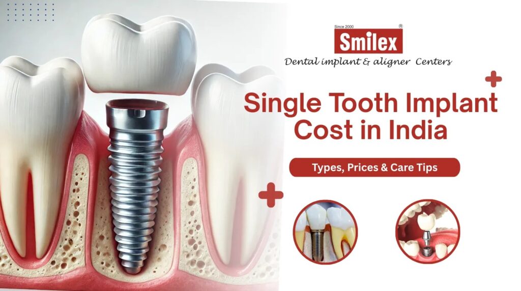 single tooth dental implant
