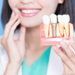 Same-Day Dental Implants Treatment