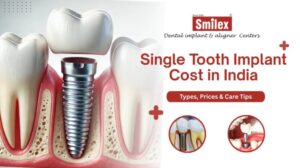 Single Tooth Implant Cost in India