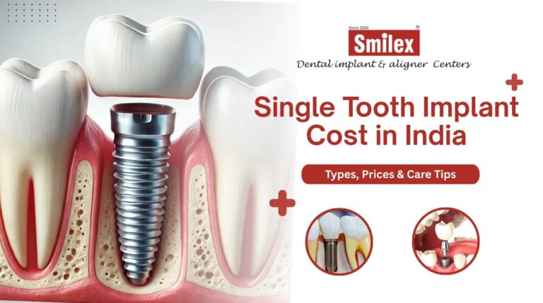 Single Tooth Implant Cost in India