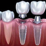 Titanium Implant Cost in India