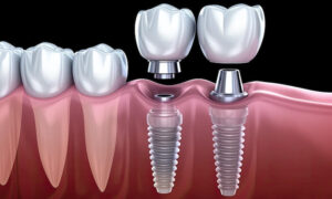 Titanium Implant Cost in India
