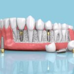 Dental Implants in Pune