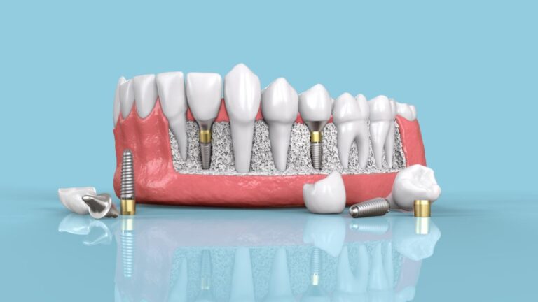 Dental Implants in Pune