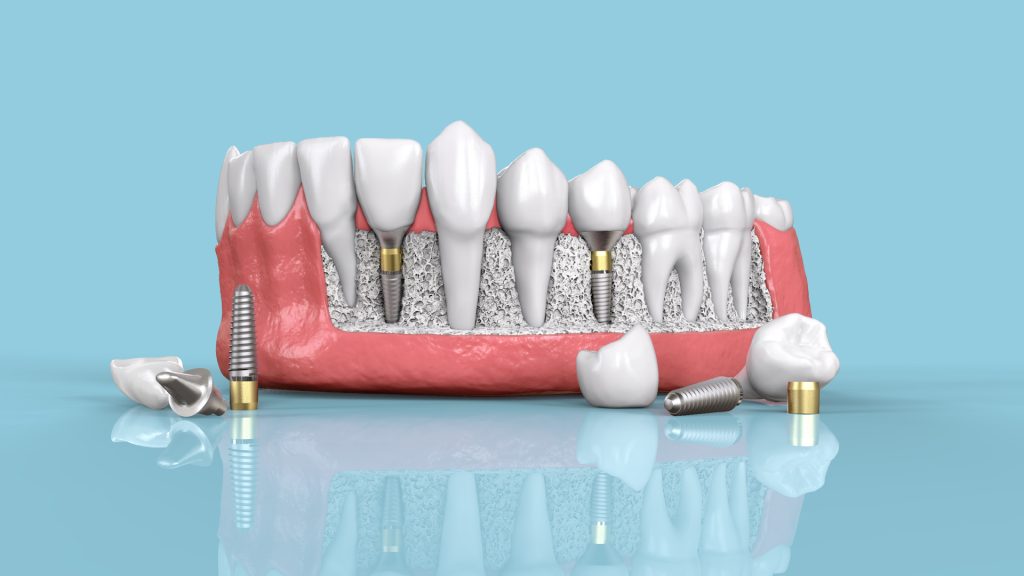Dental Implants in Pune
