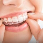 Invisalign cost in pune