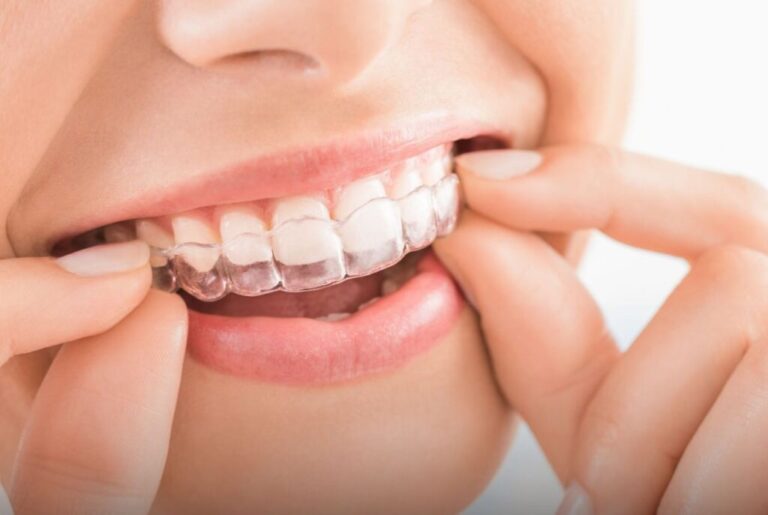 Invisalign cost in pune