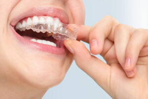 invisalign in pune