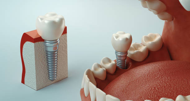 Dental Implants in Pune