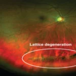 Lattice-Retinal-Degeneration (1)