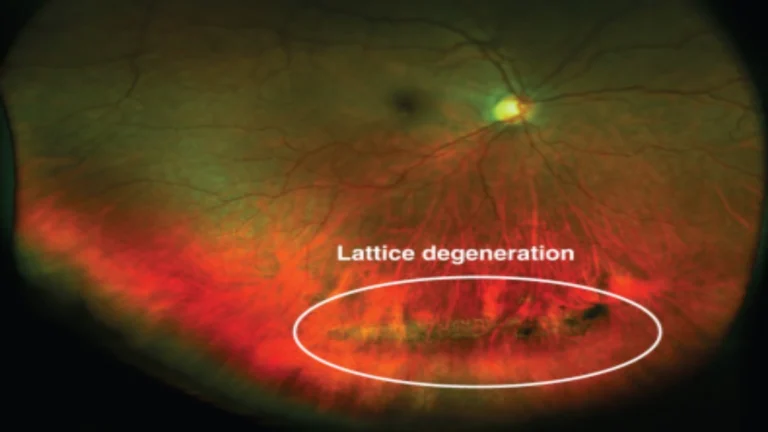 Lattice-Retinal-Degeneration (1)