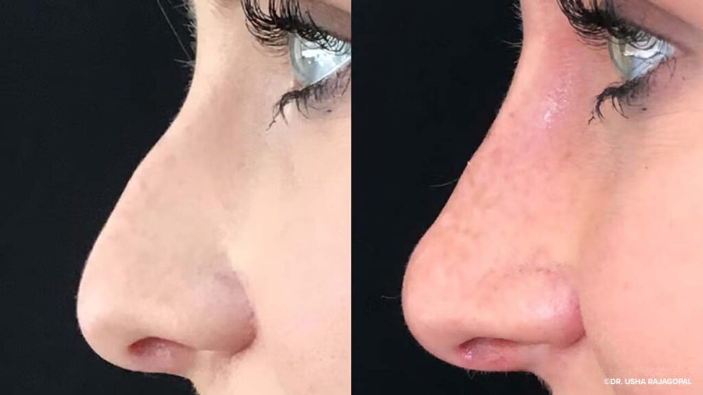 Nonsurgical-rhinoplasty-1296x728-body1