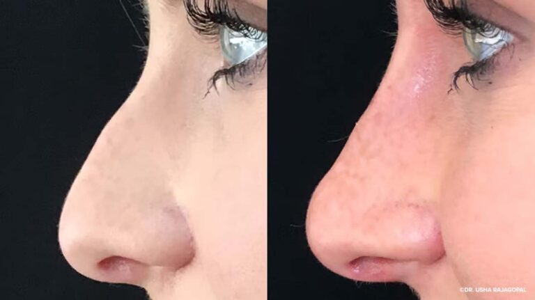 Nonsurgical-rhinoplasty-1296x728-body1