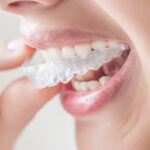 Invisalign treatment in Pune