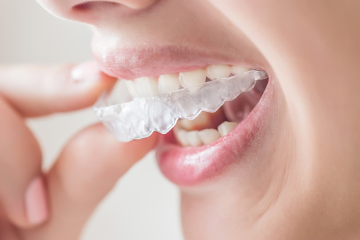 Invisalign treatment in Pune