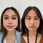 Jawline botox before and after results showing slimmer facial contours naturally