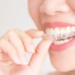 Invisible Braces Pune,