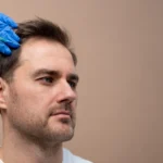 PRP hair treatment Toronto