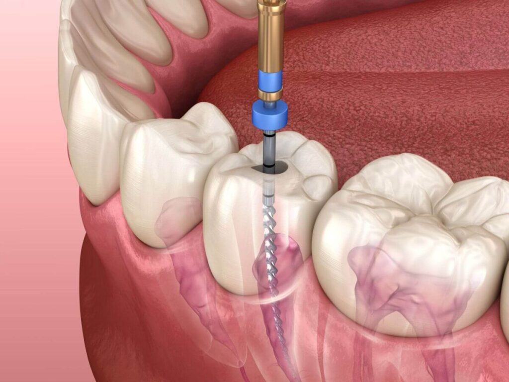 Root Canals West Point MS