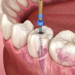Root Canals West Point MS