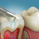 tooth colored fillings crawfordville fl