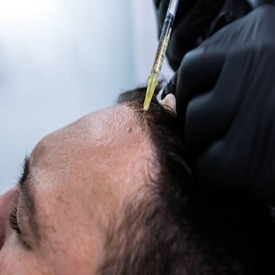 Why PRP Hair Treatment in Riyadh Is Popular for Hair Loss and Regrowth