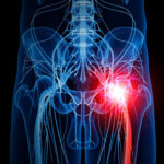 Sciatica