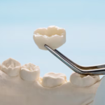 dental crowns st petersburg fl