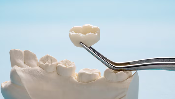 dental crowns st petersburg fl