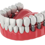 dental implants elberta al