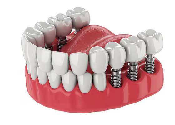 dental implants elberta al