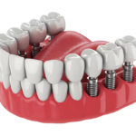 dental implants jackson tn