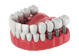 dental implants jackson tn