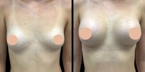 Breast Augmentation in Dubai: How to Achieve Balanced and Proportional Results