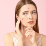 Acne-in-Adults-2