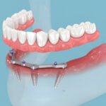 Same-Day Dentures: Your Solution for Immediate Smiles A Quick Path to Confidence