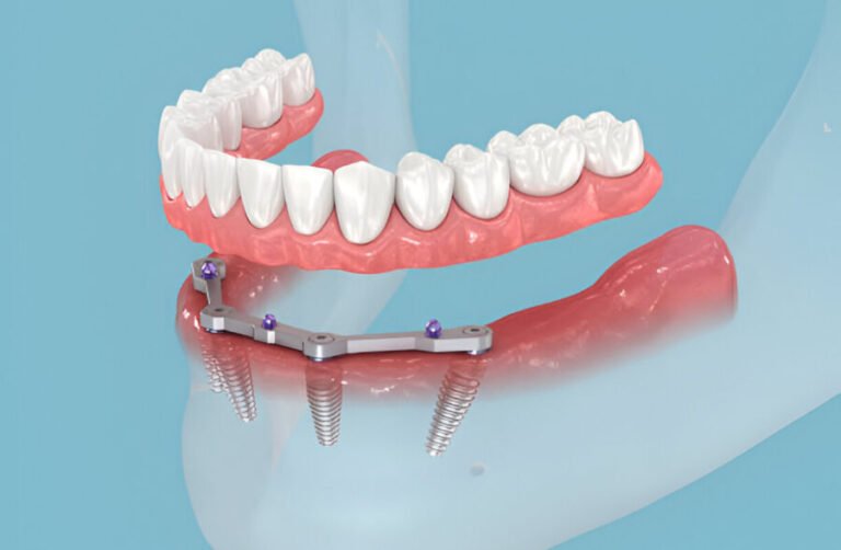 Same-Day Dentures: Your Solution for Immediate Smiles A Quick Path to Confidence
