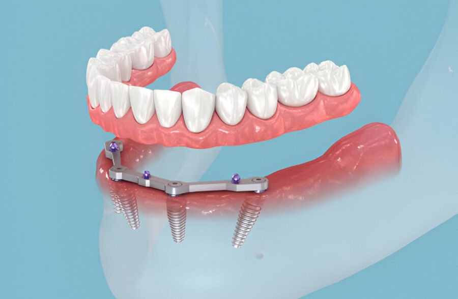 Same-Day Dentures: Your Solution for Immediate Smiles A Quick Path to Confidence