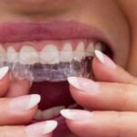 Clear Aligners Pell City AL for Comfortable and Discreet Teeth Straightening