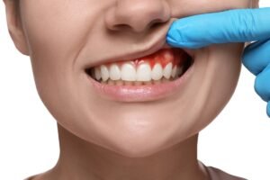 Dental Care Bremen GA for Healthy Teeth, Gums, and Confident Smiles