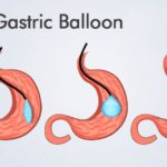 Gastric-Balloon