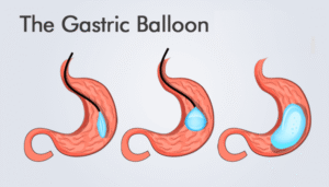 Gastric-Balloon
