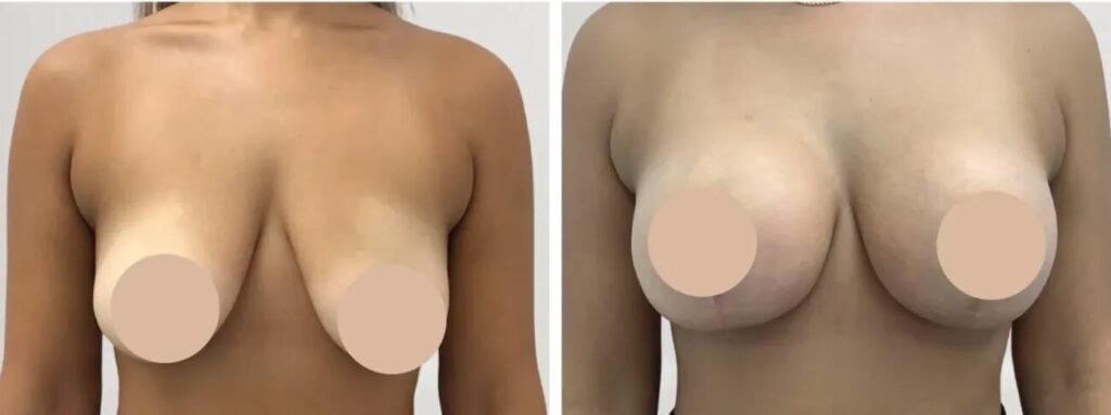 Breast Reduction Surgery in Dubai