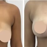 Breast Reduction Surgery in Dubai