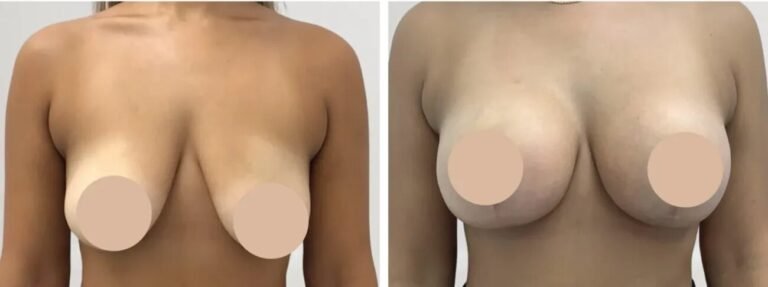 Breast Reduction Surgery in Dubai