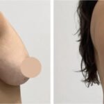 Breast Lift Surgery in Dubai