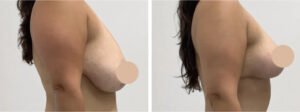 Breast Lift Surgery in Dubai
