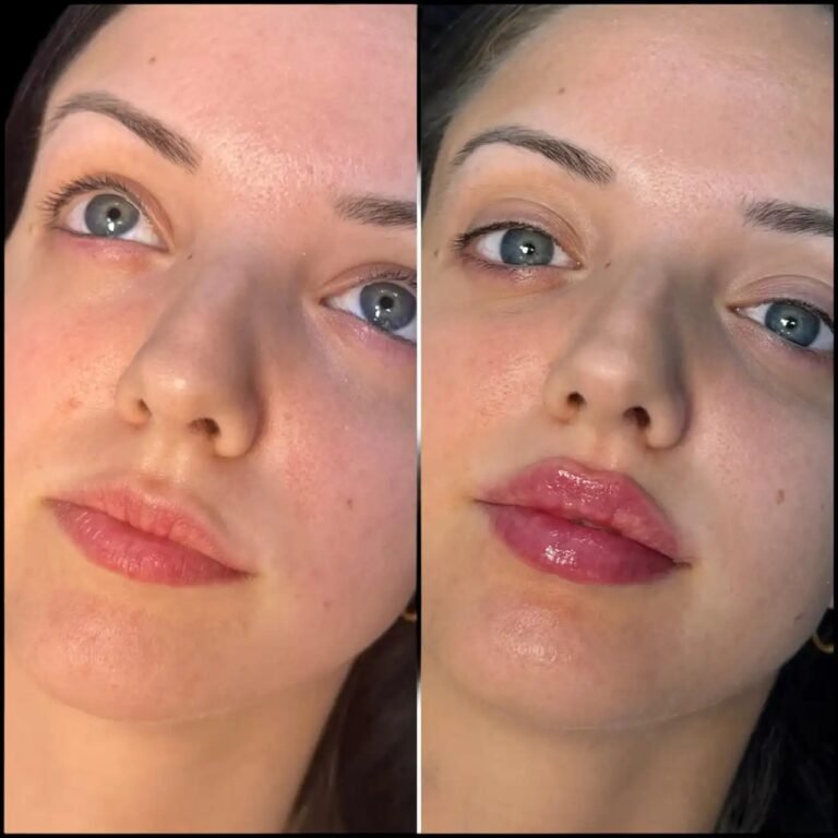 dermal fillers in dubai