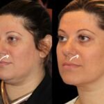 sculptra in dubai