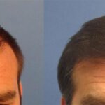 Strip Hair Transplant